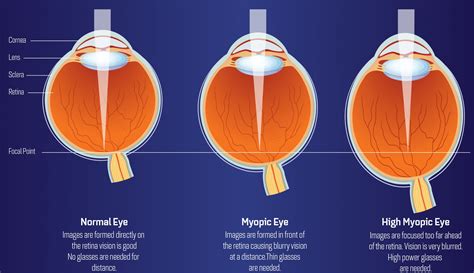 Does Myopia Cause Headaches - tacitceiyrs