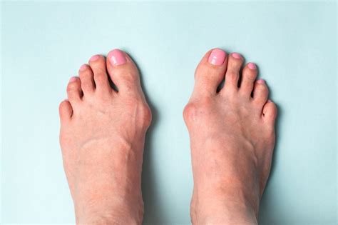 Bunion Symptoms, Causes, Treatment Fort Myers Podiatrist - Foot & Ankle Group