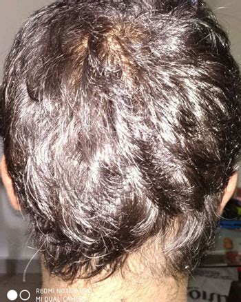 Alopecia Areata Hair Regrowth Success Story