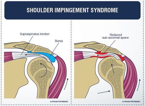 Shoulder Impingement – Irritable Shoulder Pain and Physiotherapy | Palm Beach Physiotherapy Centre