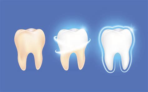 Tooth Enamel Erosion and prevention | Altima Dental Canada