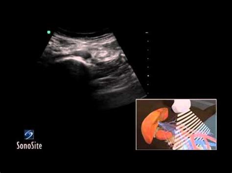 3D How to: Abdominal Aorta Ultrasound - SonoSite Ultrasound - YouTube