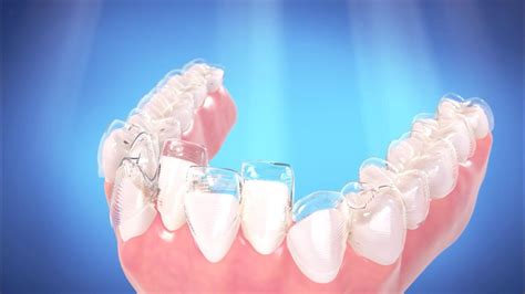 How Invisalign Works - YouTube