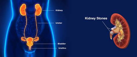 Kidney Stone Treatment in Bandra, Mumbai - Painless Kidney Stone Removal ∧ Cost