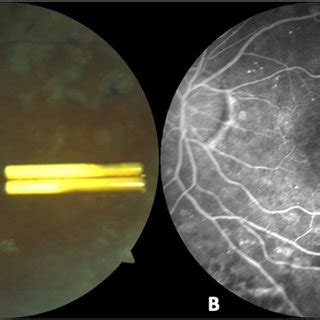 Fundus and fluorescein angiography images of the left eye Fundus image... | Download Scientific ...