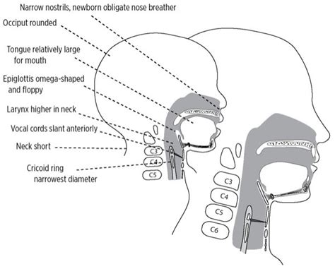 The Pediatric Upper Airway Is Prone to Obstruction