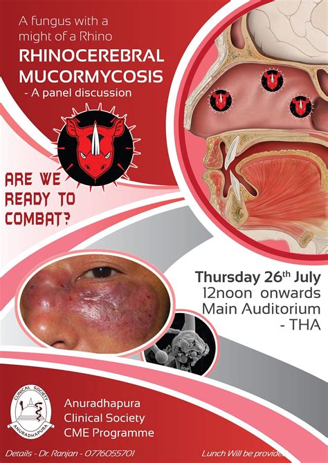 ANURADHAPURA CLINICAL SOCIETY: Rhinocerebral Mucormycosis - A Panel ...