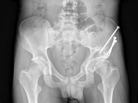 Periacetabular Osteotomy for Acetabular Dysplasia | Orthopaedic Surgeon In Wantrina, Melbourne ...