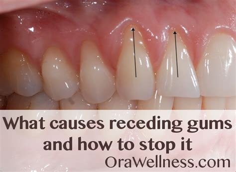 What causes receding gums and how to stop it - OraWellness