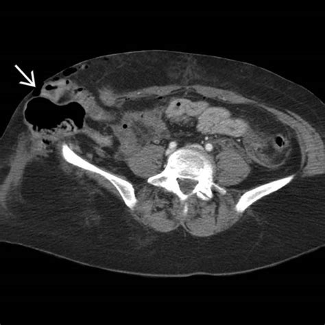 Traumatic Abdominal Wall Hernia | Radiology Key