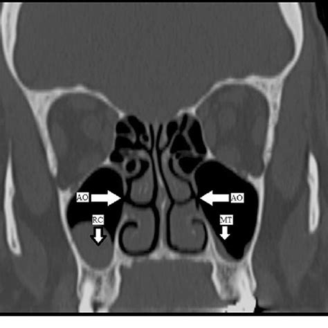 The effect of the presence of the accessory maxillary ostium on the maxillary sinus | Request PDF