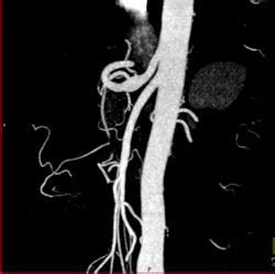 Celiac Artery Aneurysm as An Incidental Finding - Kidney Case Studies - CTisus CT Scanning