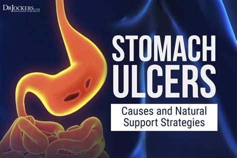 Stomach Ulcers: Causes and Natural Support Strategies - DrJockers.com