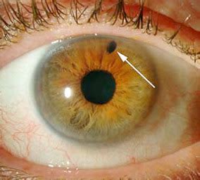 Glaucoma Laser Surgery: YAG PI