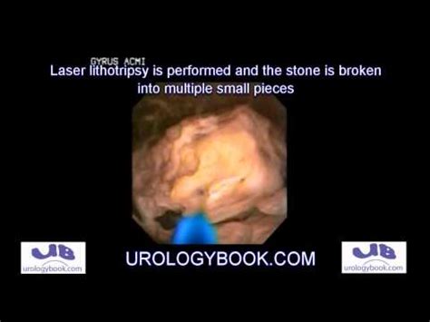 Ureteroscopy With Laser Lithotripsy