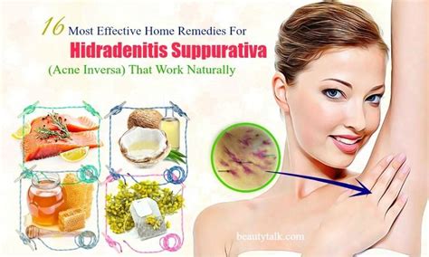 16 Effective Home Remedies For Hidradenitis Suppurativa That Work | Home remedies, Remedies ...