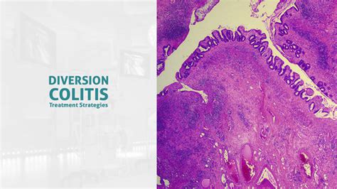 Diversion Colitis - Ulcerative Colitis Causes And Symptoms / Diversion colitis can be easily ...