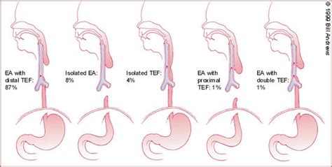 Esophageal Atresia and Tracheoesophageal Fistula | AAFP