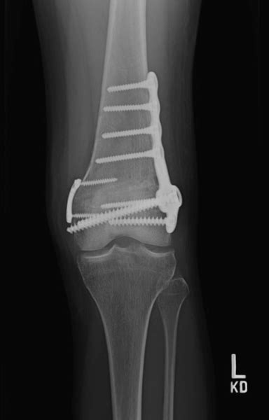 Distal Femoral Osteotomy Sparks, Carson, NV | Femur Fracture Reno, NV