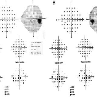 Visual field of the patient showing central scotoma and paracentral... | Download Scientific Diagram