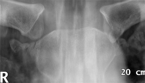 Sternoclavicular Joint Dislocation • LITFL • Trauma library