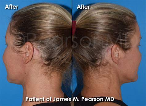 Neck Lift Photos - Before & After - Dr. James Pearson Facial Plastic Surgery