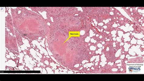 Miliary Tuberculosis Histology