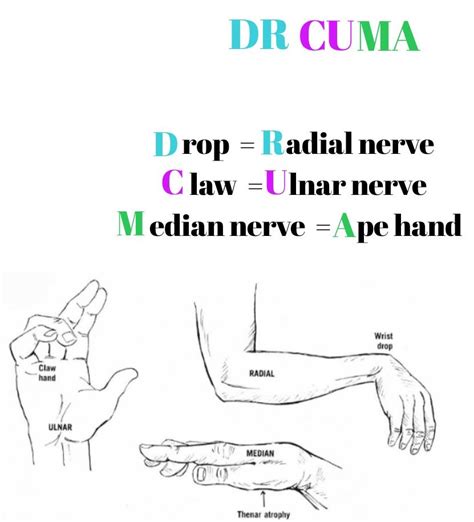 Ape Hand Median Nerve Palsy