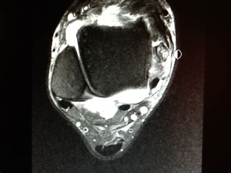 Foot and Ankle Problems By Dr. Richard Blake: Posterior Tibial Tendon ...