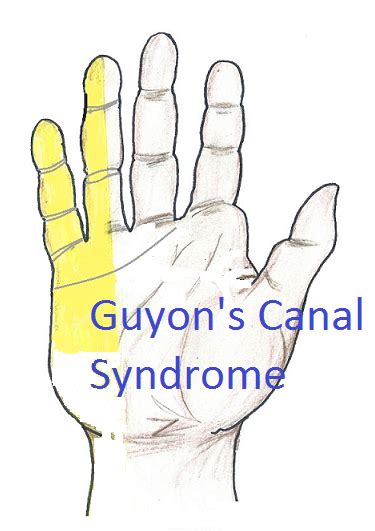 Guyon's Canal Syndrome | eHealthStar