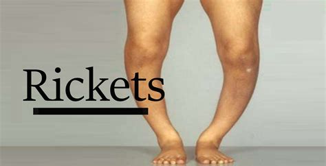 Rickets disease adults – Ericvisser