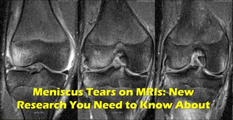 Meniscus Tear MRI? - Please Read This