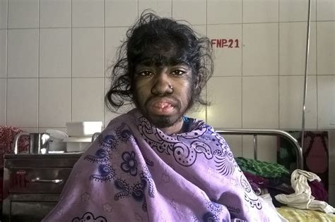 Babies contract 'Werewolf Syndrome' from tainted formula