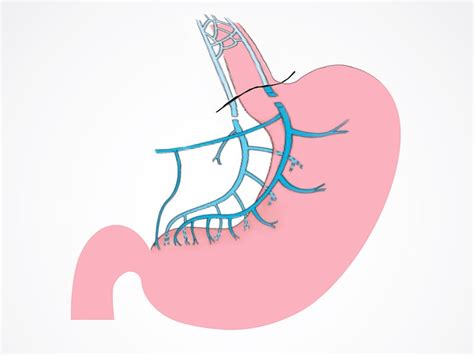 Truncal Vagotomy May Protect Against Parkinson's (Transcript)