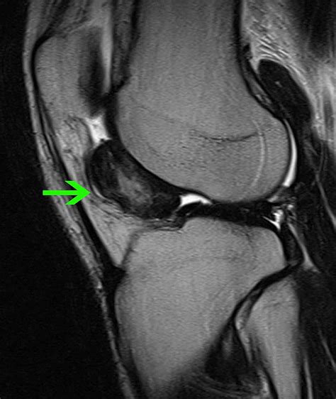 Arthroscopic Technique for the Treatment of Localized Pigmented ...