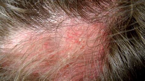 Alopecia and systemic Lupus erythematosus: correlations not to be underestimated - Insalaco Clinic