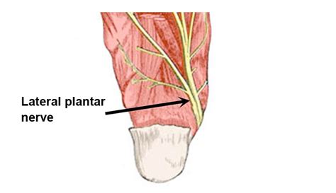 Lateral Plantar Nerve Entrapment - Symptoms, Causes & Treatment