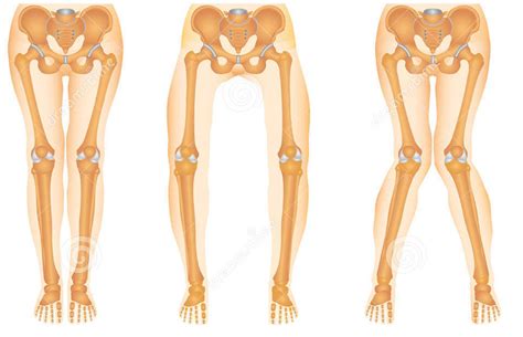 Genu Valgum(Cross Leg) Best Way of Treatment