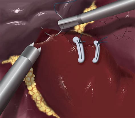 Surgical Illustration - Partial Nephrectomy on Behance