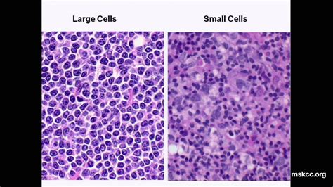 What You Need to Know about Non-Hodgkin's Lymphoma: Presentation | Non hodgkins lymphoma ...