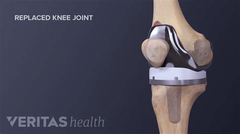 Understanding The Risks Of Knee Replacement Surgery - Ask The Nurse Expert