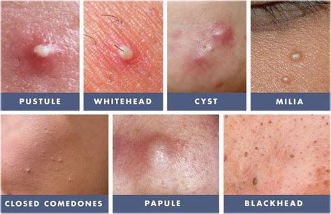 Acne Vulgaris | Getcured Apothecary Pvt Ltd