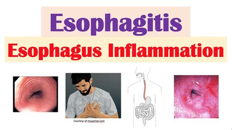 Esophagitis Types Symptoms Risk Factors Treatment And More Page | My ...