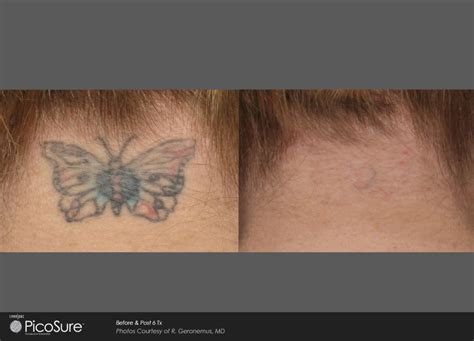 PicoSure Laser Tattoo Removal | Mansfield Cosmetic Surgery Center