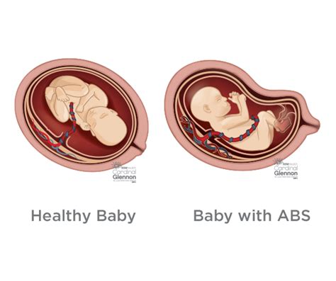 Amniotic Band Syndrome | SSM Health