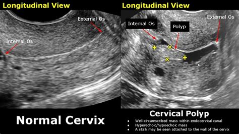 Internal Cervical Os Model Canal