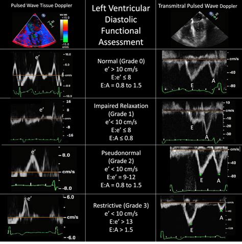 Diastolic Lv Function | IUCN Water