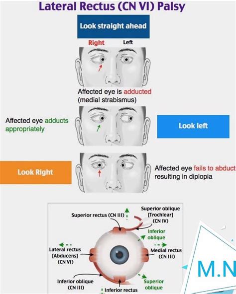 6th Nerve Palsy: - Ophthalmology-Notes And Synopses