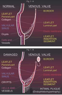 Histopathology of great saphenous vein valves in primary venous ...