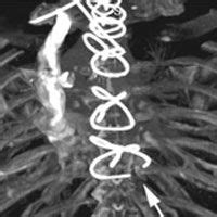 Wiring Sternum After Heart Surgery